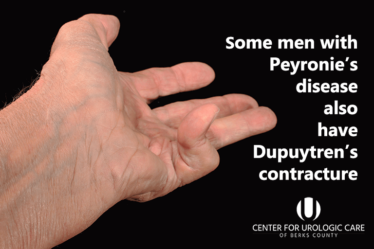 Some men with Peyronie's disease also have Dupuytren's contracture.